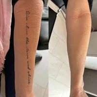 ۴۰٪ تخفیف پاک کردن تتو و خالکوبی با لیزرQ-switch|خدمات آرایشگری و زیبایی|کرمانشاه, |دیوار