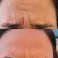 تخفیف بوتاکس،ژل لب،پی ار پی فقط تا فردا(۱ آبان)|خدمات آرایشگری و زیبایی|یاسوج, |دیوار
