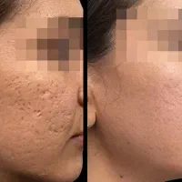 آف مزوتراپی و مزونیدلینگ|خدمات آرایشگری و زیبایی|اهواز, گلستان|دیوار