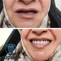 های دنت تخصصی ترین لابراتوار دندان مصنوعی(اقتصادی)