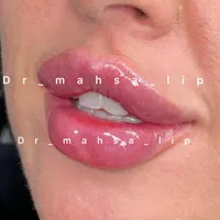 پزشک زیبایی تزریق ژل گونه فیلرچانه لب روسی مادلینگ|خدمات آرایشگری و زیبایی|تهران, پونک|دیوار