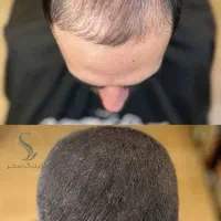 کاشت ابرو با ۱۰ میلیون تومان|خدمات زیبایی و سلامت|تهران, سازمان برنامه شمالی|دیوار