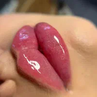 کلینیک ژل بوتاکس فیلر مزو آنزیم نخ لیفت پزشک عمل