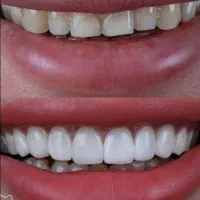 دندانپزشکی تخفیف جشنواره تا 15 مرداد معادل با بیمه