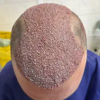 کاشت مو فقط با پرداخت ۱۰ میلیون|خدمات آرایشگری و زیبایی|تهران, جردن|دیوار