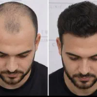 کاشت مو فول تراکم با مناسب ترین قیمت