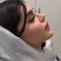 ۵۰ درصد تخفیف عمل جراحی بینی بدون تامپون با پیزو|خدمات آرایشگری و زیبایی|فردیس, طالقانی|دیوار