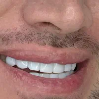 جشنواره کامپوزیت دندان فقط با ۵میلیون(نقد و اقساط)|خدمات آرایشگری و زیبایی|رشت, گلسار|دیوار
