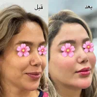 تخفیف ژل بوتاکس مزو آنزیم فیلر غبغب پی ارپی|خدمات آرایشگری و زیبایی|اصفهان, وحید|دیوار