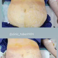 ساکشن وجراحی غبغب|خدمات آرایشگری و زیبایی|کوهدشت, |دیوار