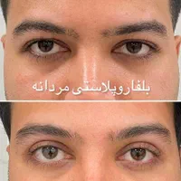 بلفارو پلک فیلر ژل لب ساکشن غبغب بوتاکس نخ سانترال|خدمات آرایشگری و زیبایی|اصفهان, مرداویج|دیوار