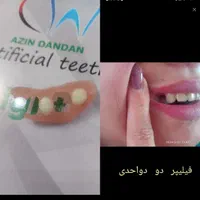 دندان متحرک مصنوعی بجای ایمپلنت فوری و سریع|آرایشی، بهداشتی، درمانی|رشت, گلسار|دیوار