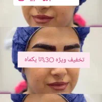 کاشت مو و کاشت ابرو اقساطی و تضمینی