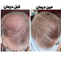 قطع دائمی ریزش مو /پرپشتی مو