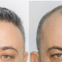 کاشت مو /کاشتمو/کاشتمو شیراز|خدمات آرایشگری و زیبایی|شیراز, قصرالدشت|دیوار