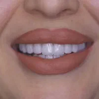 کامپوزیت دندان کامپوزیت زیبایی لمینیت دندان|خدمات آرایشگری و زیبایی|قم, قلعه یزدیها|دیوار