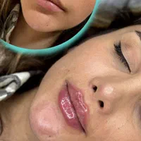 جشنواره فیلر صورت و لب در کلینیک ویرا|خدمات آرایشگری و زیبایی|شهرکرد, |دیوار