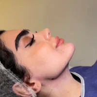 وی لاین تکنیک انحصاری کیلینیک مهرزاد ساکشن غبغب|خدمات آرایشگری و زیبایی|تهران, الهیه|دیوار