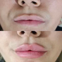 تزریق فیلر بادی/مزو ژل/ ژل/بوتاکس با بهترین متریال