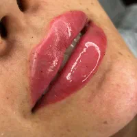 تزریق ژل لب روسی طبیعی توسط پزشک متخصص|خدمات آرایشگری و زیبایی|چهاردانگه (تهران), |دیوار