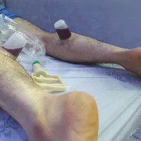 حجامت درمانی فیزیوتراپی وروغن و بادکش ورزشی