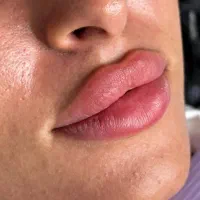ژل بوتاکس فیلر زاویه سازی خط لبخند لیزر مطب پزشک|خدمات آرایشگری و زیبایی|قم, ارم|دیوار