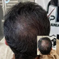 میکرواسکالپ اسکراپ کاشتمو درمجموعه زیبانو|خدمات آرایشگری و زیبایی|مشهد, گوهرشاد|دیوار