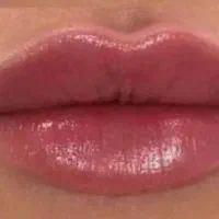 تزریقات ژل وبوتاکس