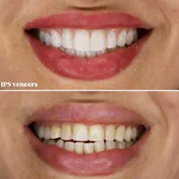دندانپزشکی قسطی در مطب لنگرود|خدمات آرایشگری و زیبایی|لاهیجان, گلستان|دیوار