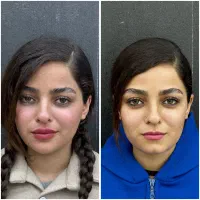 تزریق ژل و بوتاکس در ممسنی / اقساط