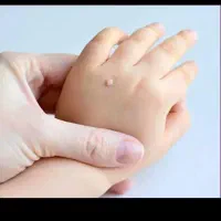 خال زگیل منگوله پوستی .جای جوش.کک مک.خال گوشتی