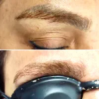 لیزر کیوسویچ پاک کردن تاتو ابرو و بدن لیزر بدن