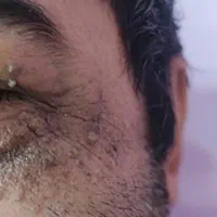 برداشت میخچه خال زگیل جراحی لیپوم لیزری توسط پزشک|خدمات آرایشگری و زیبایی|مشهد, توس (بلوار توس)|دیوار