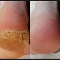 پدیکور وماساژ درمانی تازانو باز کردن رگ های گرفته