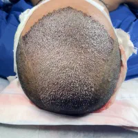 کاشت مو|خدمات آرایشگری و زیبایی|آبادان, |دیوار