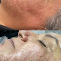 فیان جوانساز و رفع افتادگی و رفع لک