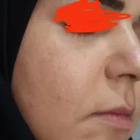 کرم ضد لک گیاهی|آرایشی، بهداشتی، درمانی|اهواز, کمپلو شمالی|دیوار