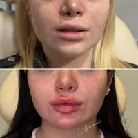 آموزش ژل و بوتاکس