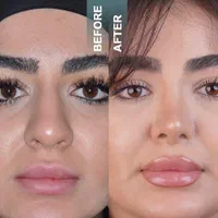 کامپوزیت لمینت ایمپلنت جراحی بینی بلفارو ساکشن|خدمات آرایشگری و زیبایی|مشهد, سجاد شهر|دیوار