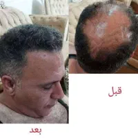کاشت مو و ابرو|آرایشگاه و سالن‌های زیبایی|تهران, جردن|دیوار