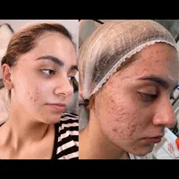 فشیال پاکسازی لیزر پوست جوانساز|خدمات آرایشگری و زیبایی|شیراز, معالی‌آباد|دیوار