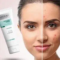 کرم ژل انتی اکنه گاتیو|آرایشی، بهداشتی، درمانی|نائین, |دیوار