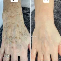 آموزش فیلر،بوتاکس،مزو،مزو ژل با مدرک|خدمات آموزشی|آبادان, |دیوار