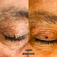 برداشتن انواع خال گوشتی،زگیل،منگوله،کک مک|خدمات آرایشگری و زیبایی|شیراز, شهرک امیر کبیر|دیوار