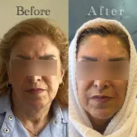 ژل،فیلر،بوتاکس،مزوتراپی با تخفیف‌های باورنکردنی|خدمات آرایشگری و زیبایی|تهران, جماران (نیاوران)|دیوار