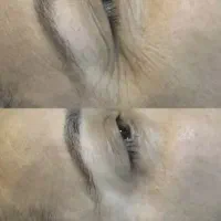 بیوممتیک، جوانساز جهانی، متد کلاژن سازی ایتالیایی