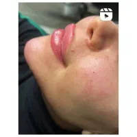 فیلر‌‌ صورت /  ژل صورت