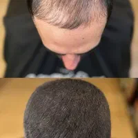 کاشت مو با دستگاه بدون جراحی