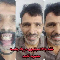 جایگزین ایمپلنت|خدمات آرایشگری و زیبایی|یزدان شهر, |دیوار