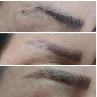 ریموو تتو صورت وبدن